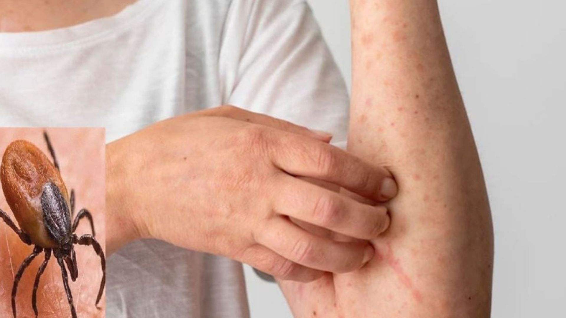  ప్రజలను భయపెడుతున్న స్క్రబ్ టైఫస్..